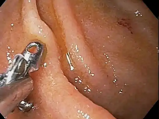 Biopsy sample collection