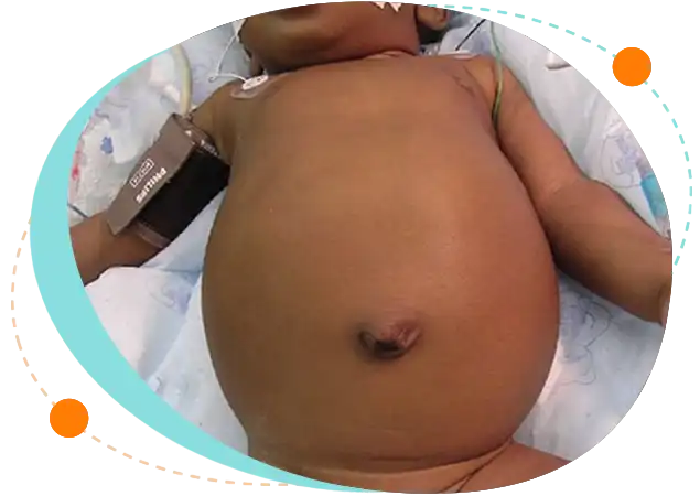 Children with severe acute malnutrition in Bangladesh