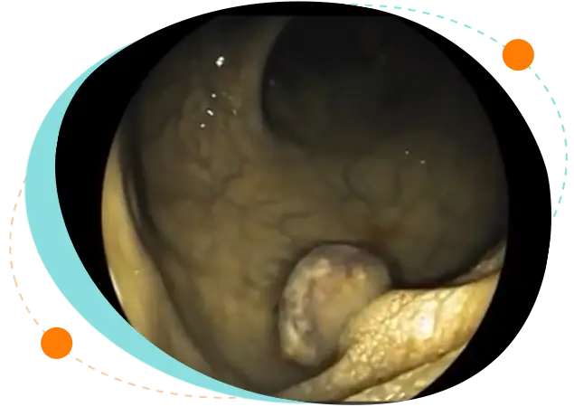 Colonoscopic polypectomy in Bangladesh