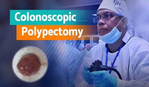 Colonoscopic Polypectomy Removal 