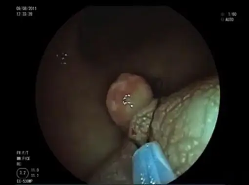 Colonoscopic Polypectomy