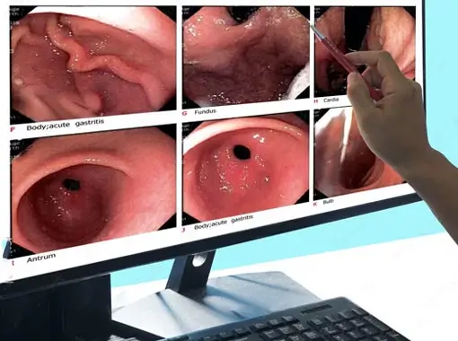 Colonoscopy