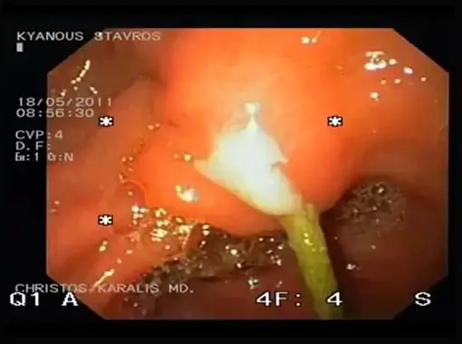 Endoscopic Biopsy