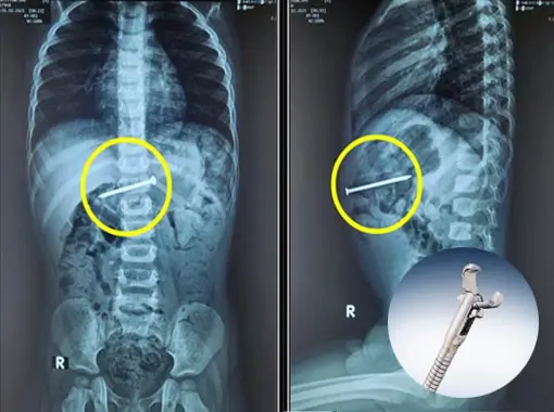 Endoscopic Foreign Body Removal