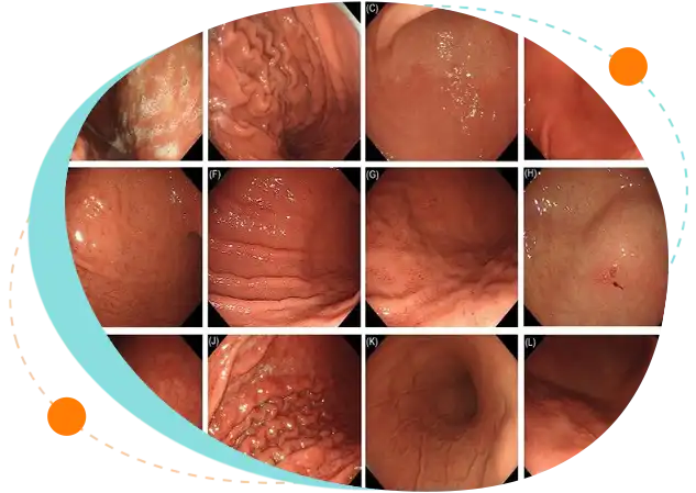 Endoscopic H. Pylori Isolation in Bangladesh