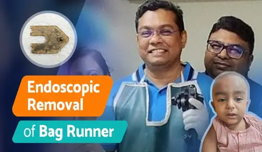 Endoscopic Removal of Bag Runner video thumb 