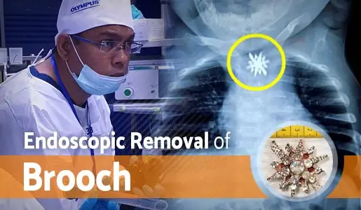 Endoscopic Removal of Brooch video thumb 