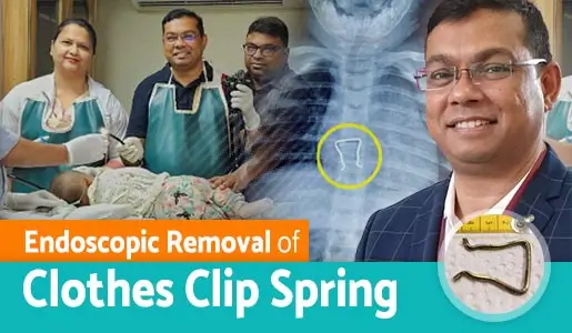 Endoscopic Removal of Clothes Clip Spring video thumb 