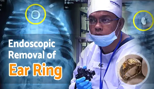 Endoscopic Removal of Ear Ring video thumb 