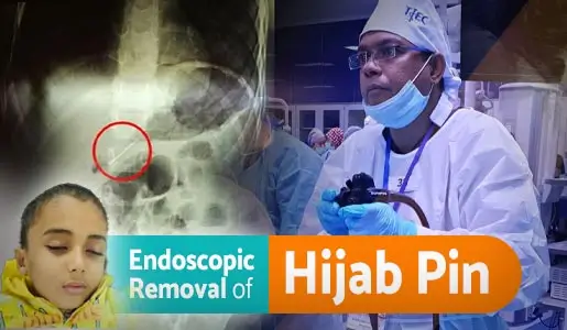 Endoscopic Removal of Hijab Pin video thumb 