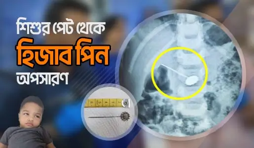 Endoscopic Removal of Hijab Pin video thumb 