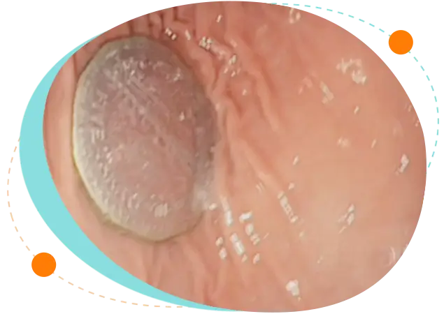 Endoscopic removal of ingested foreign body in children