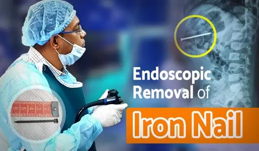 Endoscopic Removal of Iron Nail video thumb 