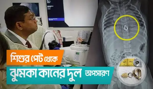 Endoscopic Removal of Jhumka Earring