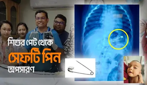 Endoscopic Removal of Safety Pin video thumb 
