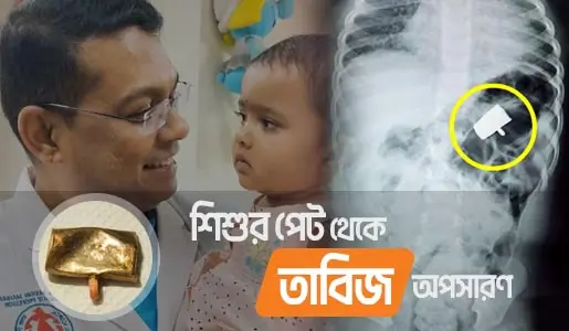 Endoscopic Removal of Tabiz video thumb 