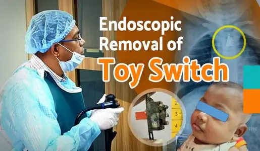 Endoscopic Removal of Toy Switch video thumb 