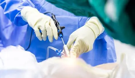 Endoscopic Stapling