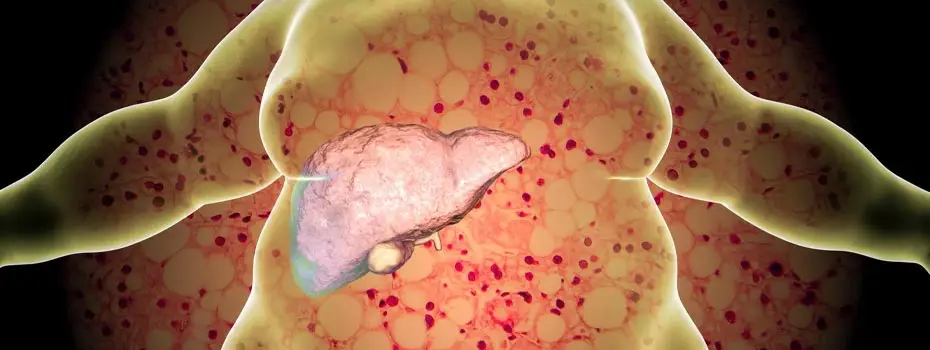 Fatty liver disease in children