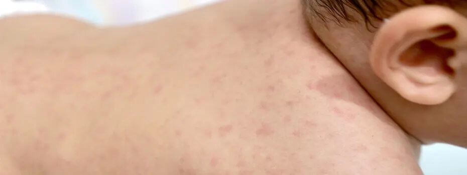 শিশুদের হাম (Measles): লক্ষণ, কারণ, চিকিৎসা ও করণীয়