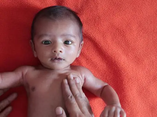 Moderate Acute Malnutrition