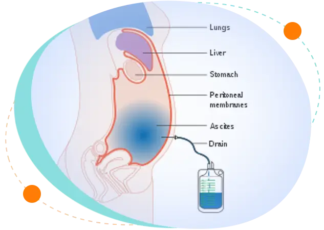 Pediatric Ascitic Tap procedures in Bangladesh