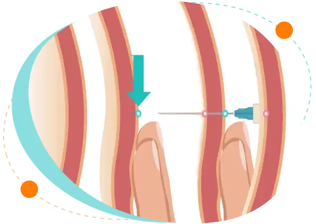 Pediatric Ascitic Tap procedures