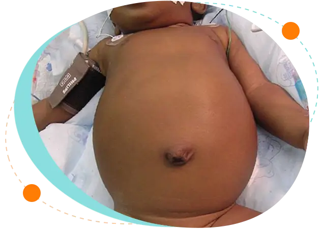 Pediatric Gastroenterology treatment in Bangladesh