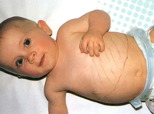 Pediatric Hepatology