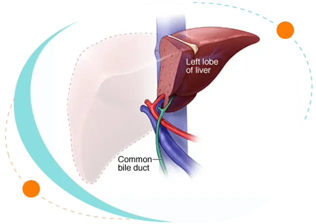 Pediatric Liver Transplant cost in Bangladesh