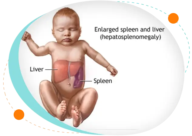 Pediatric Liver Transplant in Bangladesh