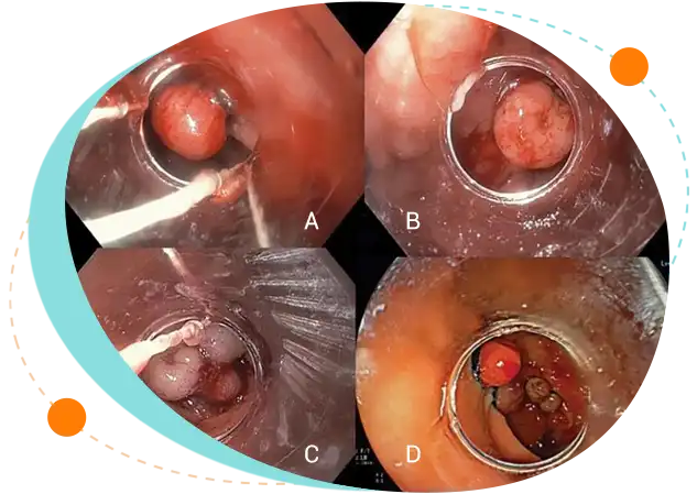 Post-banding ulceration