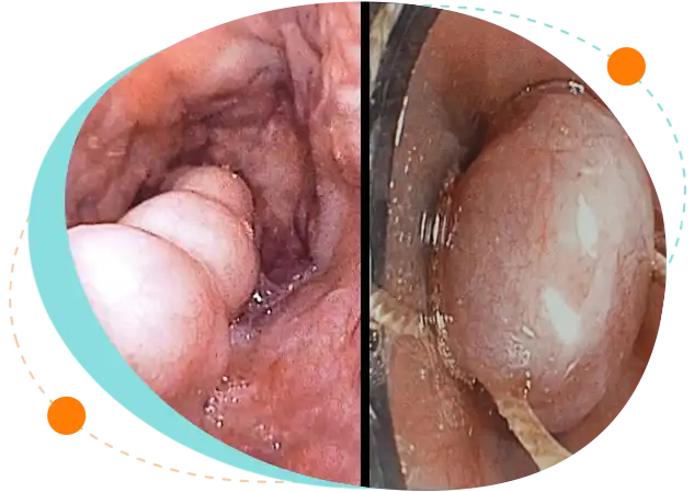 Procedure of Endoscopic Band Ligation