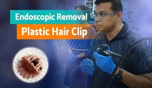 Endoscopic Removal of Plastic Hair Clip video thumb 