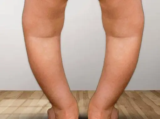 Vitamin D Deficiency (Rickets)