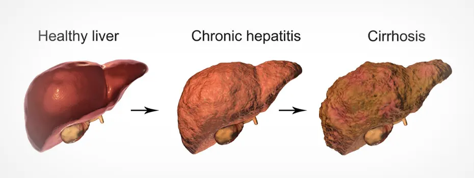 What is liver cirrhosis in children?
